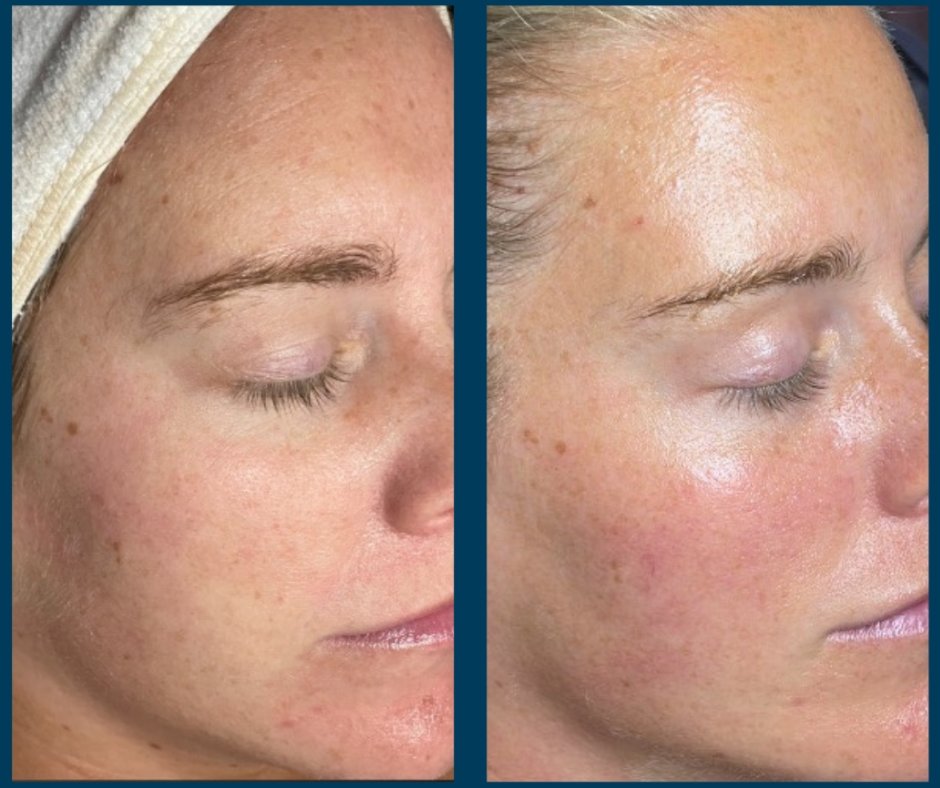 Microneedling - Before & After